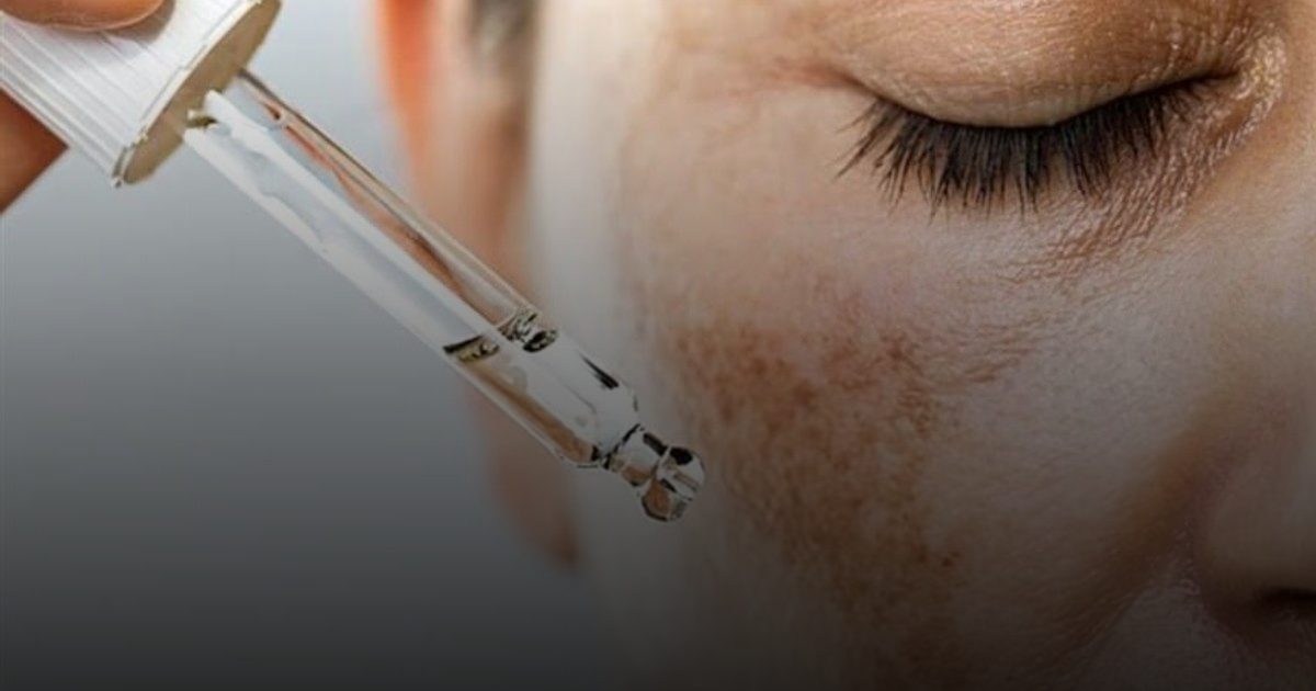 عادات يومية تزيد التصبغ وتعيق علاج البقع الداكنة