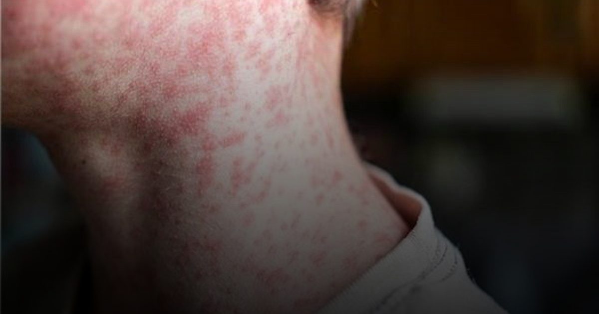 ارتفاع حاد في حالات الحصبة في المملكة المتحدة .. 151 حالة إصابة في مارس الماضي