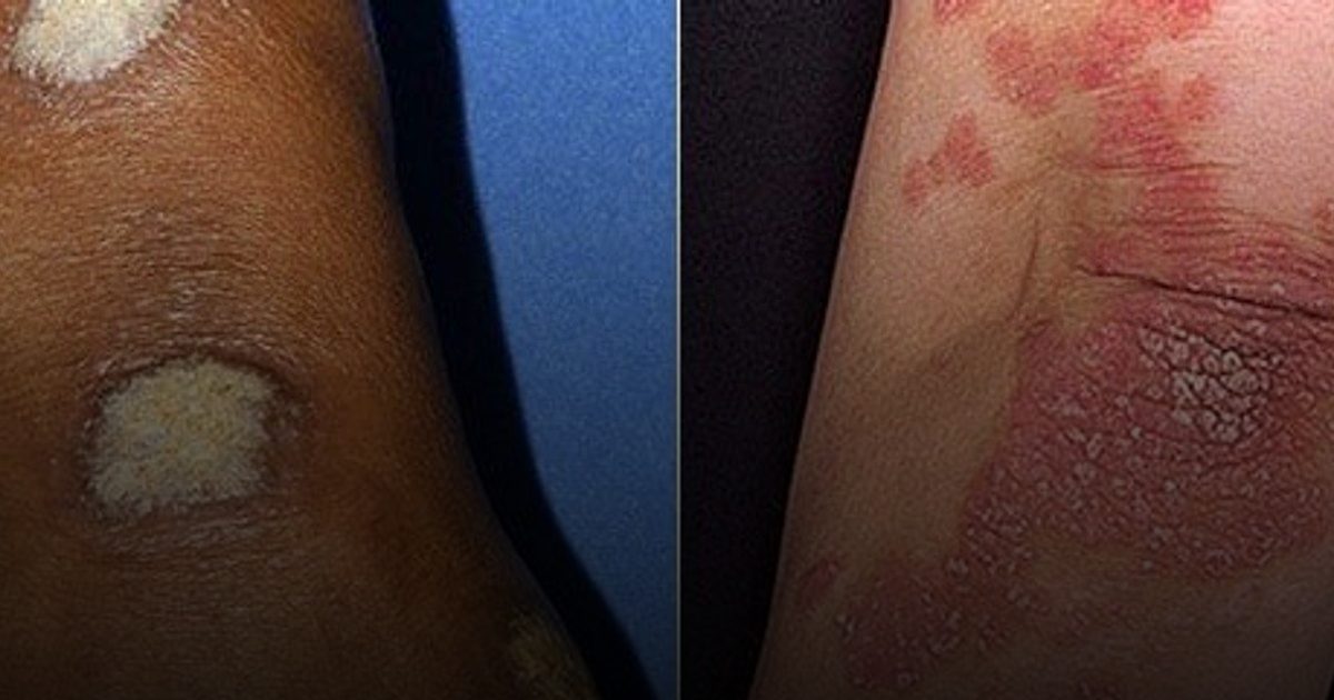 وزارة الصحة: "الصدفية" مرض مناعي مزمن وغير معدٍ يصيب 125 مليون شخص حول العالم