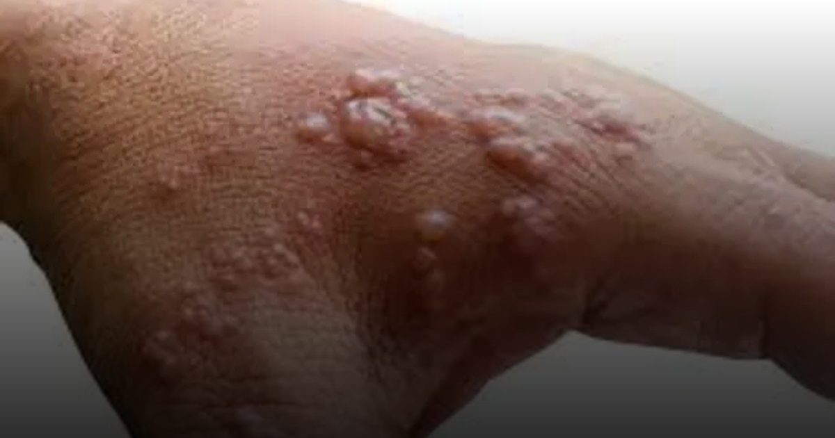 الصحة العالمية تحذر: انتشار أوسع لسلالة "Ib" من جدري القرود رغم الشفاء الذاتي