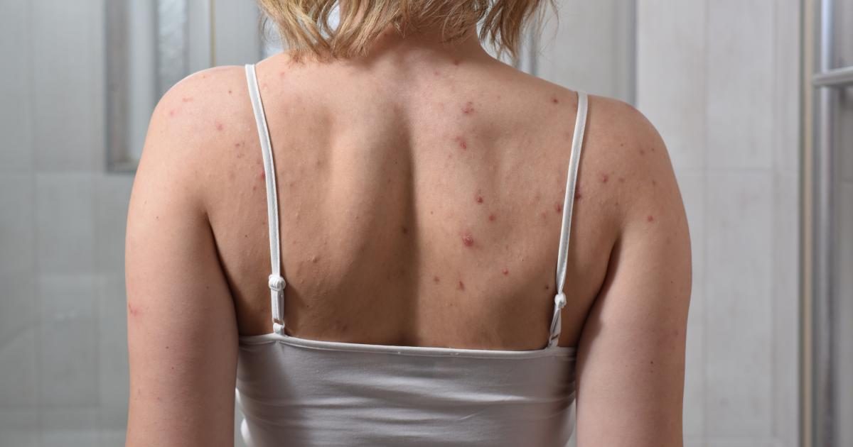 لماذا تظهر بثور الظهر وكيف نحمي البشرة من التصبغات؟