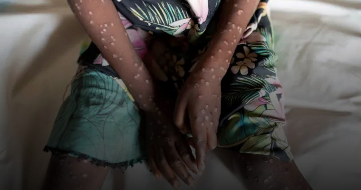 الكاميرون ترفع مستوى التأهب الصحي بسبب تفشي جدري القرود