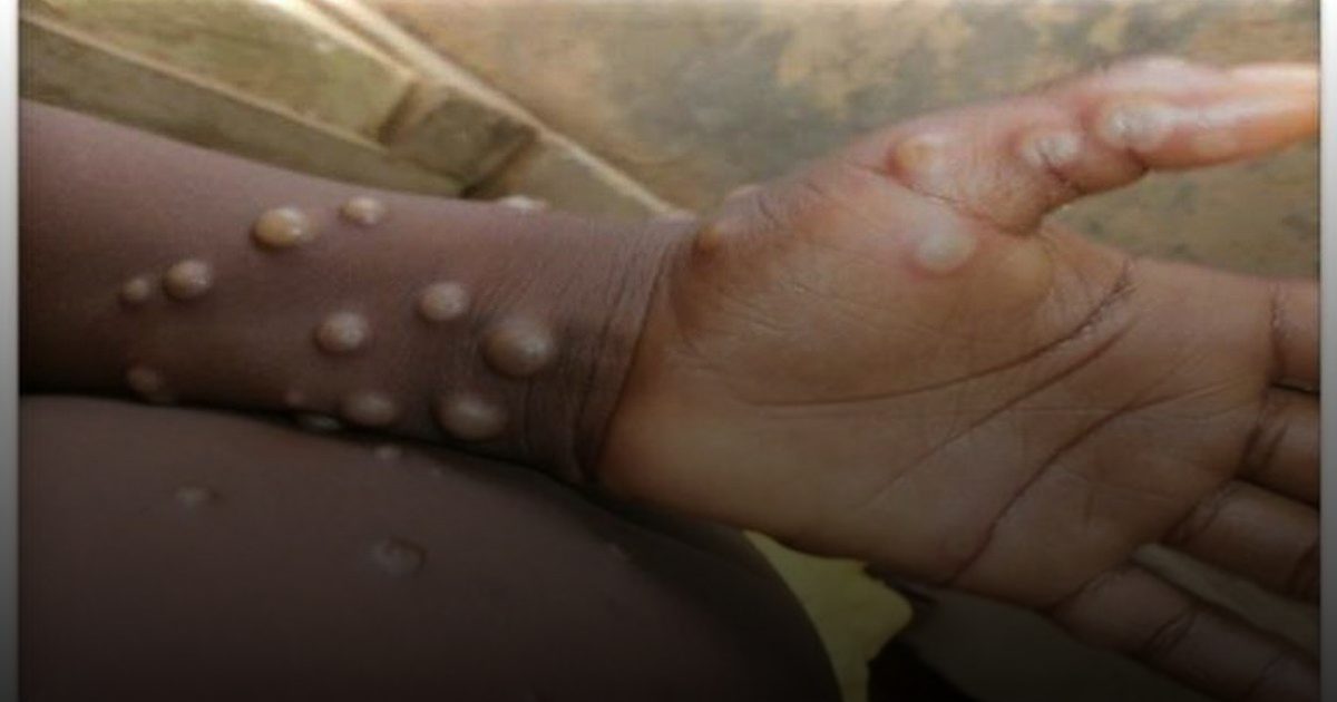 تسجيل إصابة مؤكدة بجدري القردة في السنغال