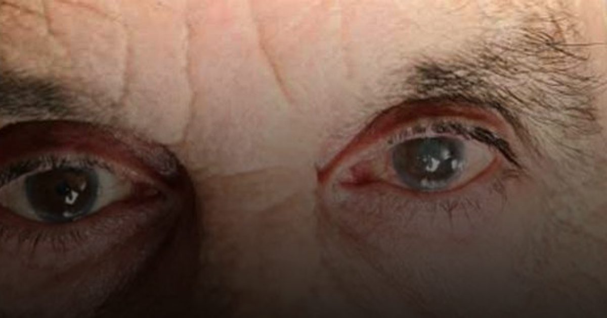 جراحة المياه البيضاء في كلتا العينين معاً آمنة