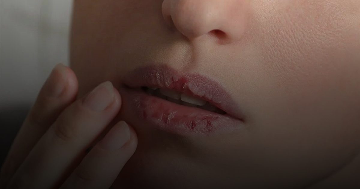 تشققات الشفاه المستمرة قد تشير إلى عدوى فطرية
