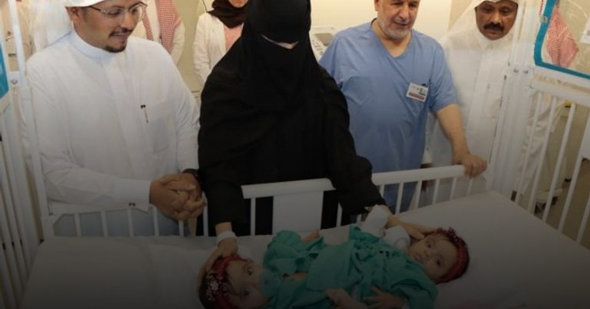 انطلاق عملية فصل التوأم السعودي «يارا ولارا»