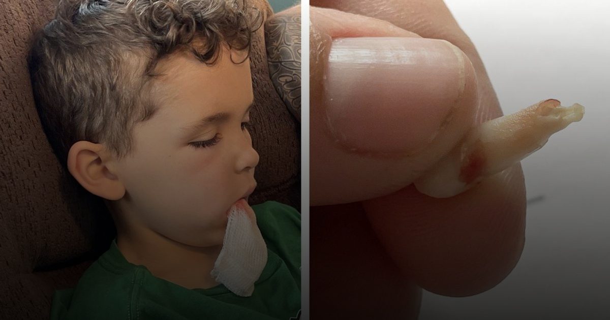 حالات طوارئ الأسنان لدى الأطفال ترتفع بشكل ملحوظ