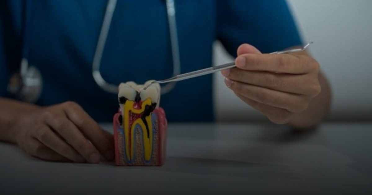 علاج قناة الجذر للأسنان يحسن من تنظيم السكر في الدم