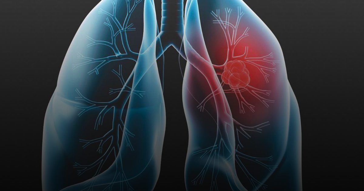 استشاري: التشخيص المبكر يحمي من مضاعفات الانسداد الرئوي المزمن