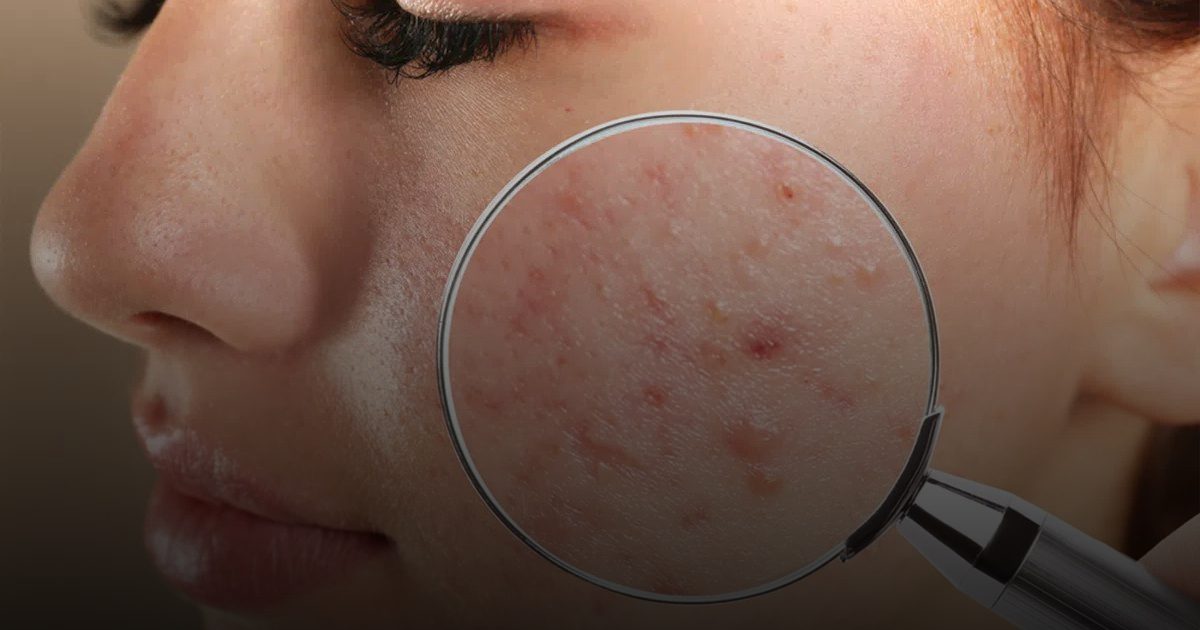 فحص الدم يساعد في اكتشاف أسباب حب الشباب