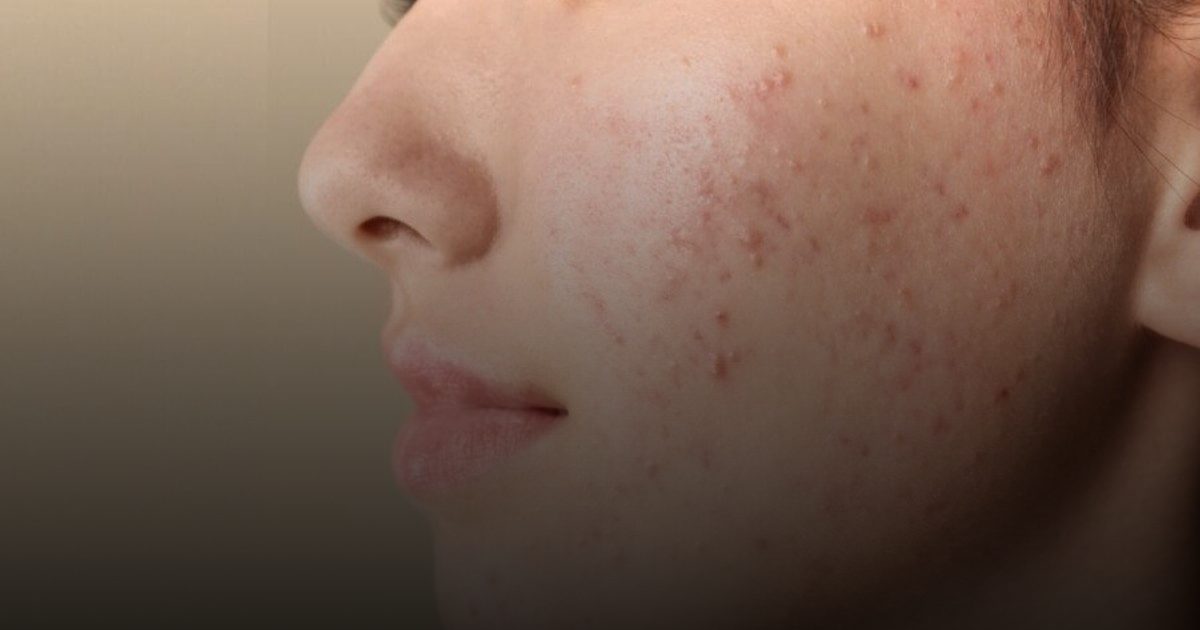 دراسة تكشف عن علاقة «حب الشباب» بالاضطرابات الغذائية