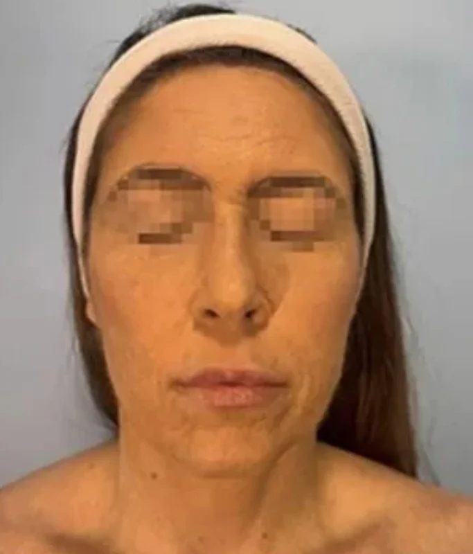 عقار شائع يسبب تقشر 55% من جلد مريضة بالبرازيل