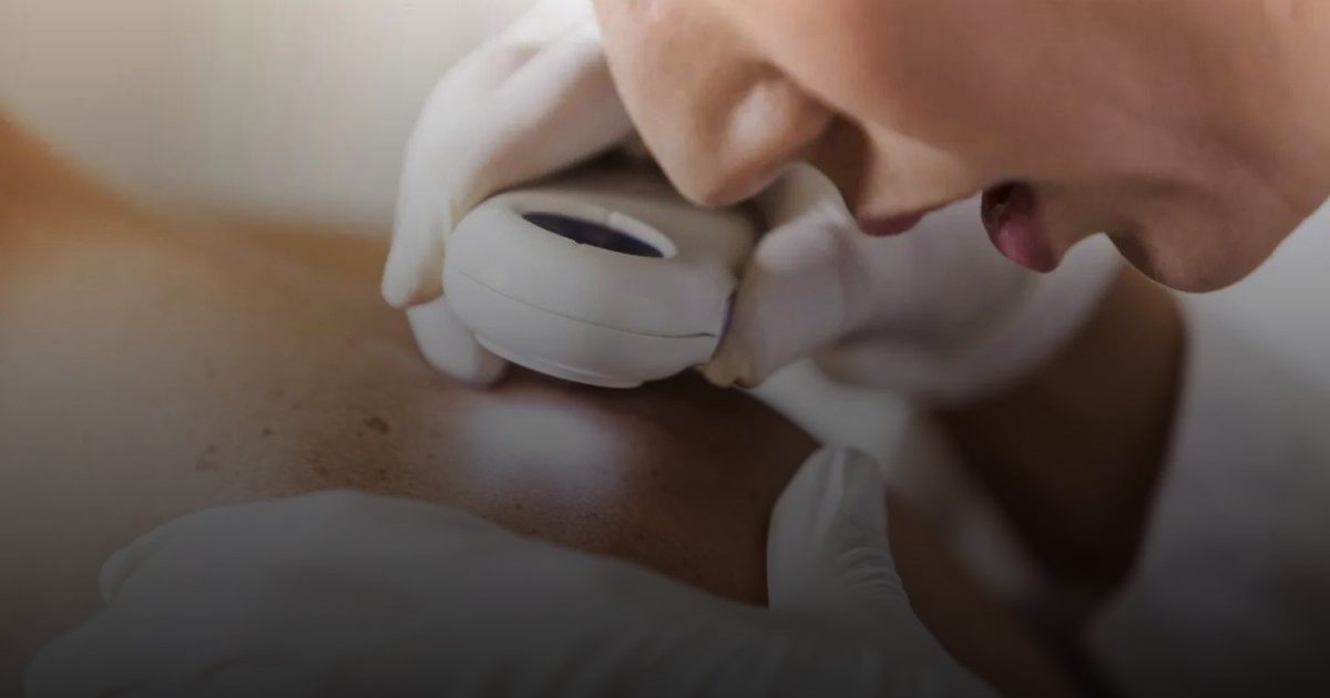 علاج جديد لسرطان الجلد المُقاوم للأدوية