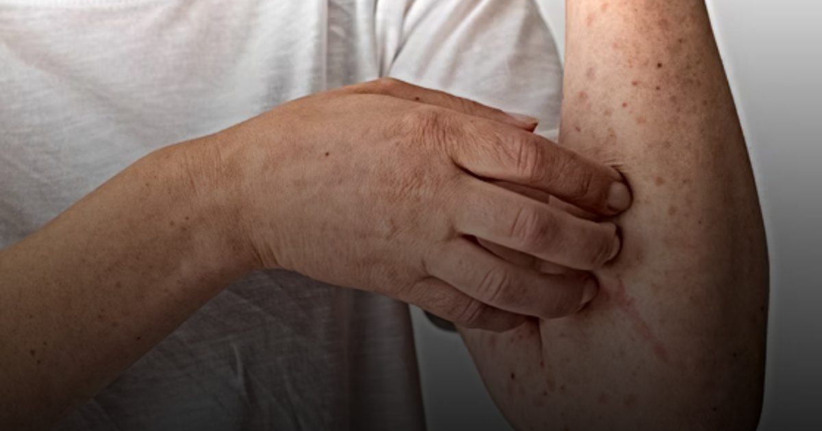 الماء والقهوة والعرق.. أنواع نادرة من الحساسية