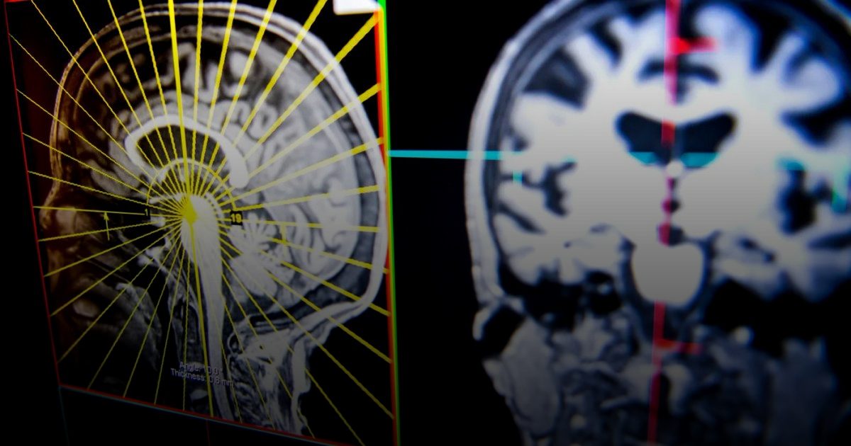 اكتشاف الطفرة الجينية المسؤولة عن الإصابة بالأمراض العقلية