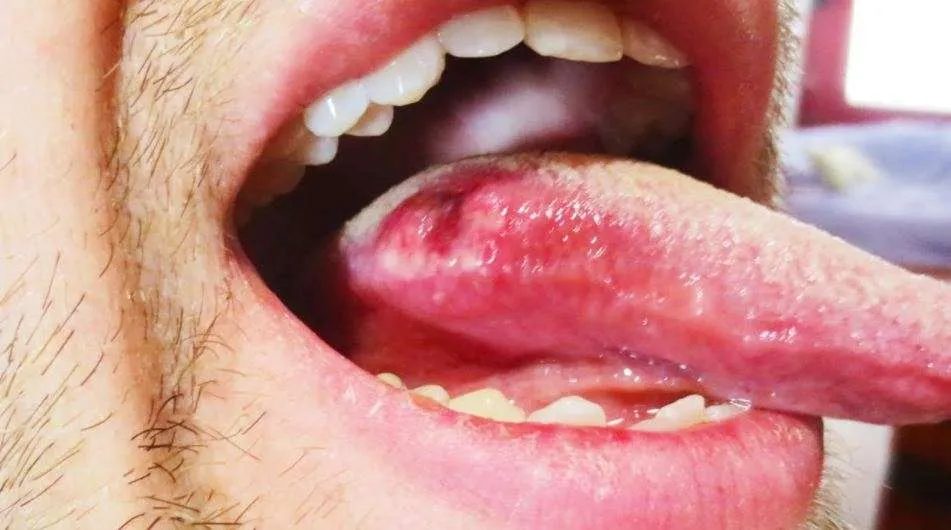سرطان اللسان يصيب مقدمته .. التدخين والخمور من مسبباته