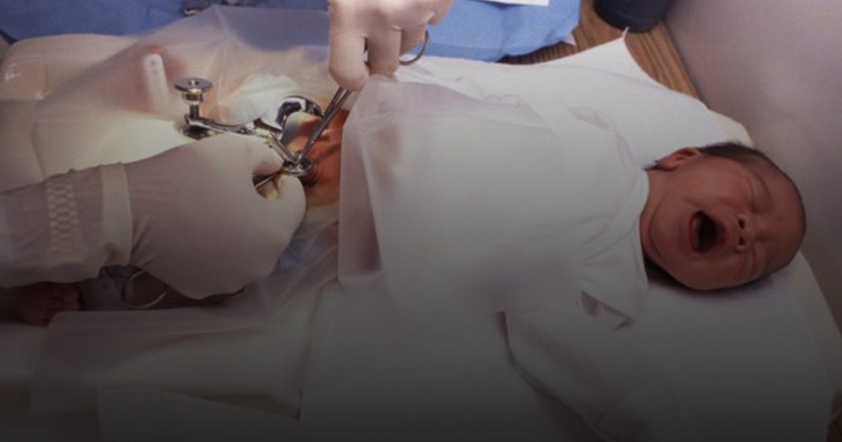 انخفاض معدلات ختان الذكور رغم فوائده الصحية