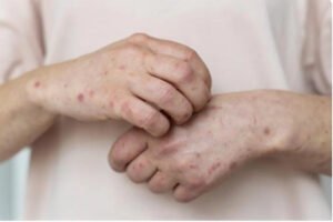 الصحة الكندية: تسجيل أول إصابة بالسلالة الفرعية 1 من جدري القردة