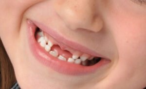 علماء يابانيون يطوّرون دواءً يعيد نمو الأسنان المفقودة