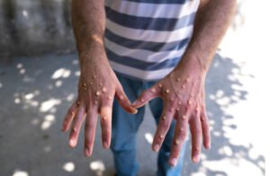 اكتشاف إصابة جديدة بجدري القردة في باكستان