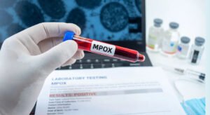 “كوسوفو” ترصد أول إصابة بجدري القردة