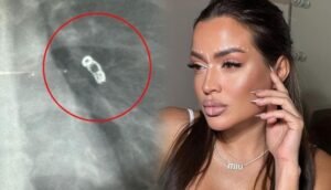 جسم معدني في رئة روسية يثير صدمة بعد سنوات من الجراحة