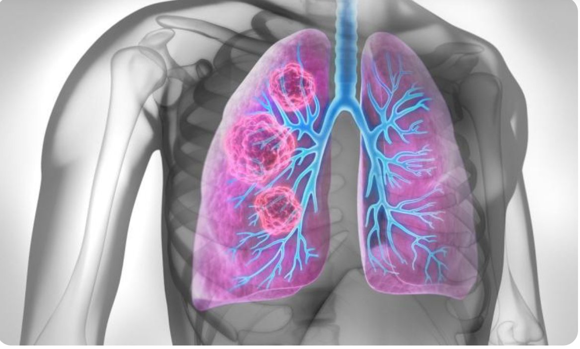 دراسة تكشف سبب انتشار مرض السرطان إلى الرئتين 