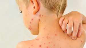 المغرب:  رسمياً الحصبة وباء  .. 25 ألف حالة إصابة منذ سبتمبر