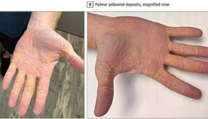 بسبب  الإفراط في تناول اللحوم ..عقد صفراء غريبة على جسم رجل