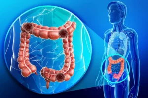 انتشار سرطان الأمعاء بين الشباب .. وحيرة العلماء