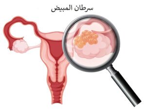 300 ألف إصابة لسرطان المبيض وأمل جديد في دواء للقلب