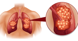 أستاذ أورام: اكتشاف سرطان الرئة مبكرا قبل ظهور العلامات يحقق شفاء بنسبة 90%