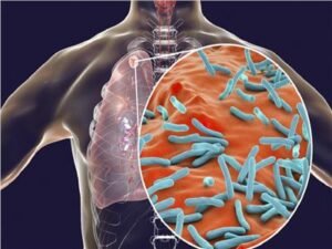 انتشار غير مسبوق لمرض السل في ولاية كانساس الأمريكية