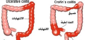 FDA  الأمريكية توافق على دواء لتخفيف أعراض مرض كرون الشديد