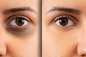 الهالات السوداء علامة على مشكلات الصحية