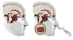 الورم البرولاكتيني..  الأكثر شيوعاً لأورام الغدة النخامية