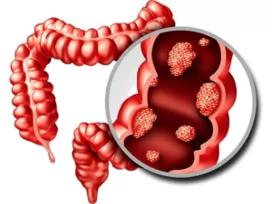 في بريطانيا .. اختبار يتنبأ بسرطان الأمعاء بدقة 90%