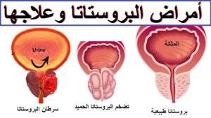 إهمال فحص البروستاتا يرفع معدلات وفيات الرجال بالسرطان