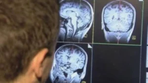 السكتات الدماغية أشد تدميراً للأشخاص الأفضل تعليماً