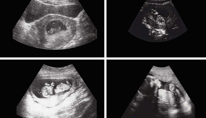 حالة نادرة.. استخراج جنين من بطن رضيع في أفغانستان 