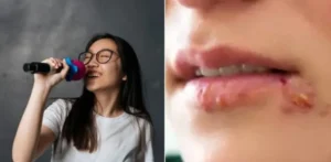 امرأة تصاب بفيروس الهربس منذ 8 سنوات..  والسبب ميكروفون