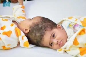 نجاح عملية فصل التوأم الملتصق الإريتري “أسماء وسمية”