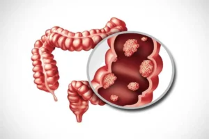 علماء يكشفون عن وجبة خفيفة قد تقلل من خطر الإصابة بسرطان القولون