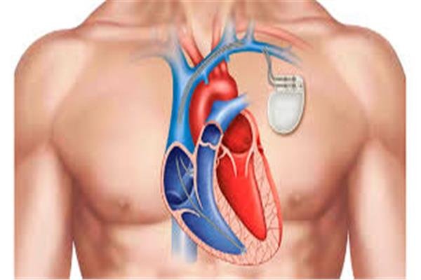 نجاح زراعة منظم دائم لضربات القلب لإنهاء معاناة مريض من اضطراب كهربي خطير 