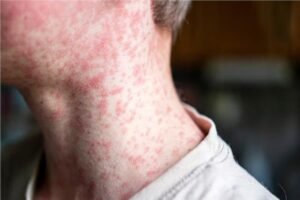 ارتفاع حاد في حالات الحصبة في المملكة المتحدة .. 151 حالة إصابة في مارس الماضي