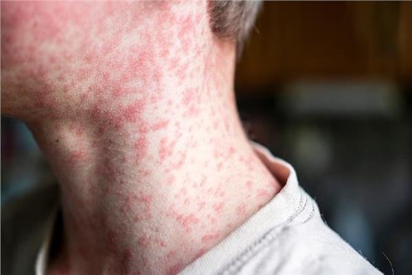 ارتفاع حاد في حالات الحصبة في المملكة المتحدة .. 151 حالة إصابة في مارس الماضي 