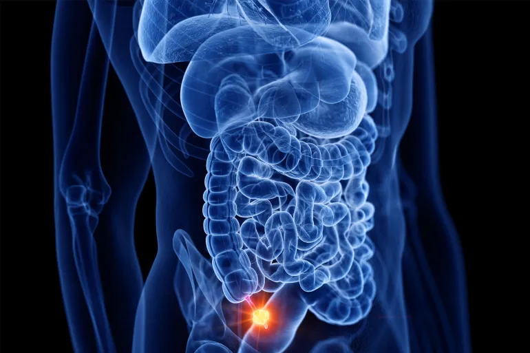 تضاعف حالات سرطان الزائدة الدودية 4 مرات في الولايات المتحدة 
