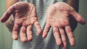 تايلاند تسجّل 40 إصابة بجدري القرود