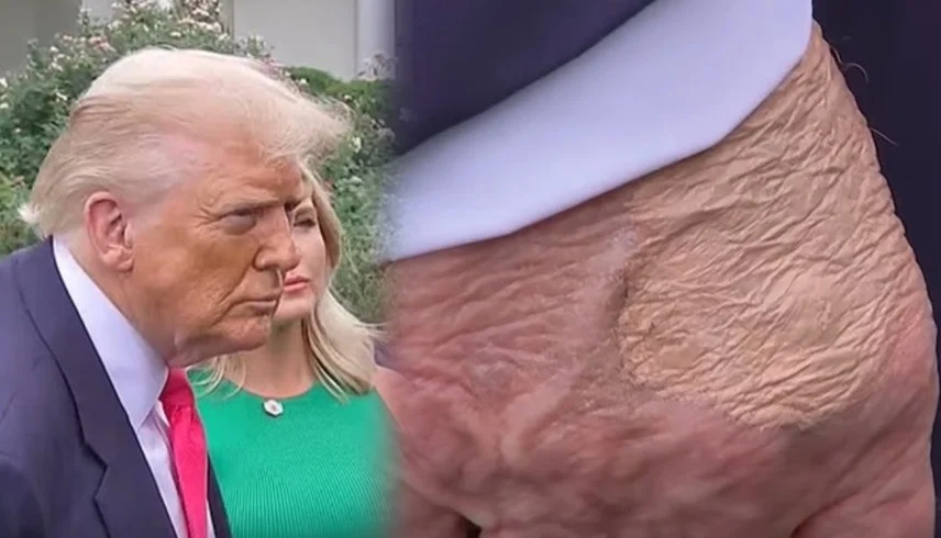 علامة غامضة على يد ترمب تثير القلق والتكهنات الطبية 