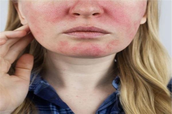 ما لا تعرفه عن «التهاب الجلد التحسسي للضوء» وأهم العلاجات 
